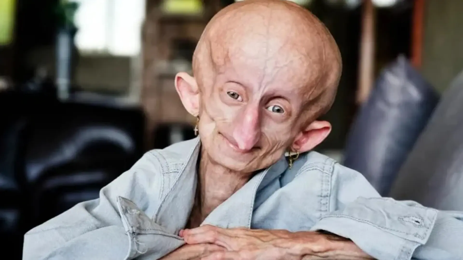 Muere a los 19 años Beandri Booysen, la ‘influencer’ que visibilizó su lucha contra la progeria