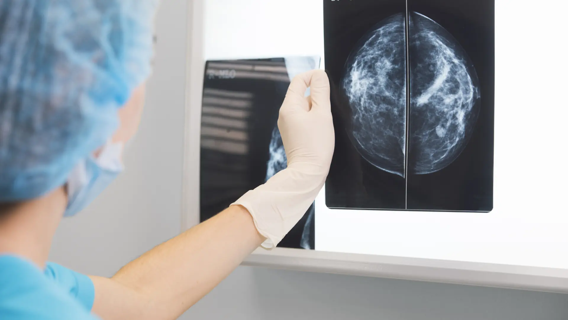 Un fármaco consigue mejorar la supervivencia en pacientes con cáncer de mama agresivo hasta diez años después Un fármaco consigue mejorar la supervivencia en pacientes con cáncer de mama agresivo hasta diez años después