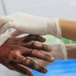 Noticias Medellín: La segunda ciudad con mayor número de quemados Noticias Medellín: La segunda ciudad con mayor número de quemados