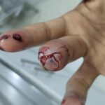 Noticias Antioquia: Medellín supero cifra de lesionados con pólvora en 2023