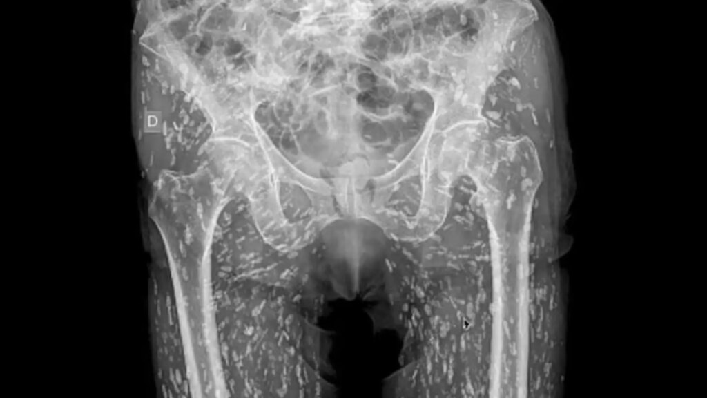 La aterradora radiografía de un hombre con una infección de parásitos alimentarios: «Están por todas partes»