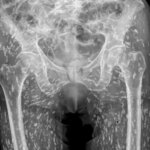La aterradora radiografía de un hombre con una infección de parásitos alimentarios: «Están por todas partes»