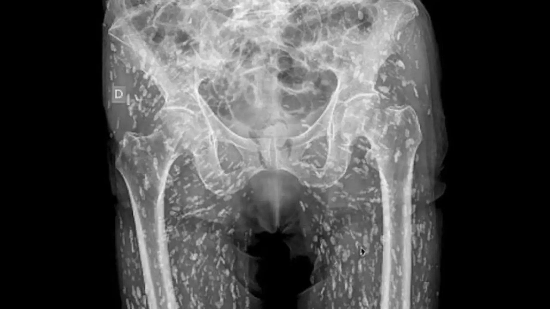 La aterradora radiografía de un hombre con una infección de parásitos alimentarios: «Están por todas partes»