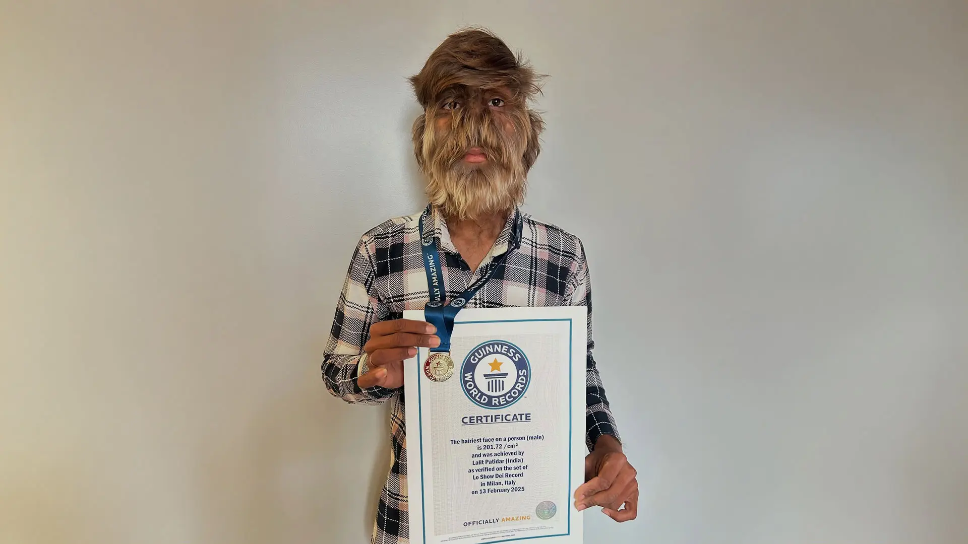 Hipertricosis congénita, el trastorno que padece el joven con la cara más peluda del mundo