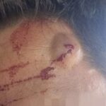 Las heridas de un guardia civil agredido con un gancho en un intento de salto a la valla de Ceuta Las heridas de un guardia civil agredido con un gancho en un intento de salto a la valla de Ceuta