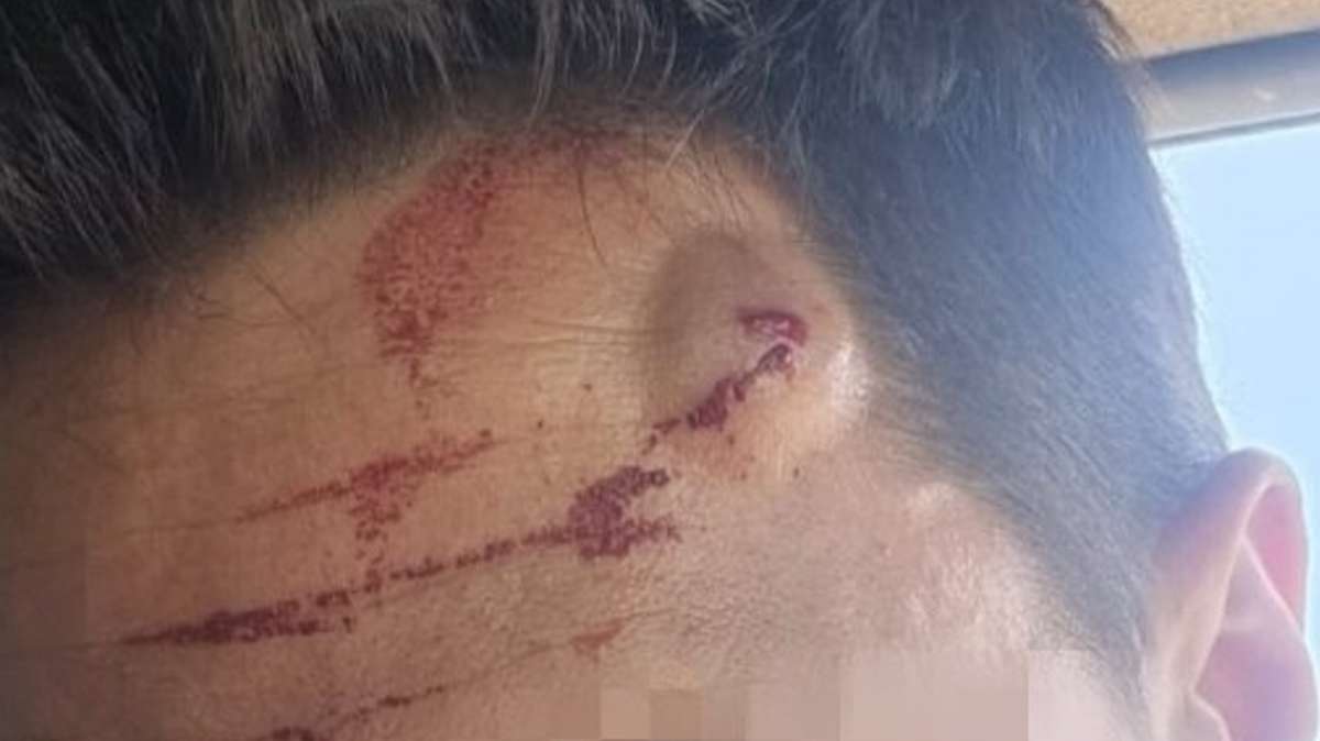 Las heridas de un guardia civil agredido con un gancho en un intento de salto a la valla de Ceuta Las heridas de un guardia civil agredido con un gancho en un intento de salto a la valla de Ceuta