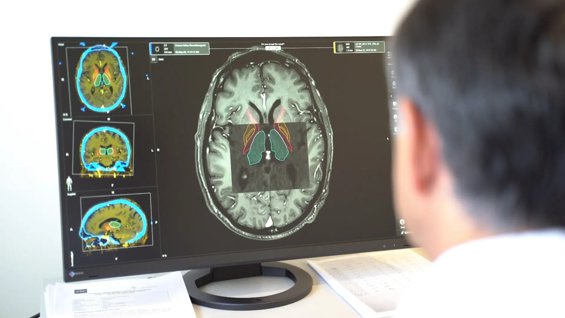 La cera de los oídos, una posible forma sencilla para la detección del párkinson
