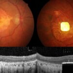 Una prótesis ocular logra devolver la vista a personas con ceguera irreversible Una prótesis ocular logra devolver la vista a personas con ceguera irreversible