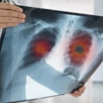 EEUU aprueba un fármaco español para el tratamiento de un tipo de cáncer de pulmón muy agresivo EEUU aprueba un fármaco español para el tratamiento de un tipo de cáncer de pulmón muy agresivo