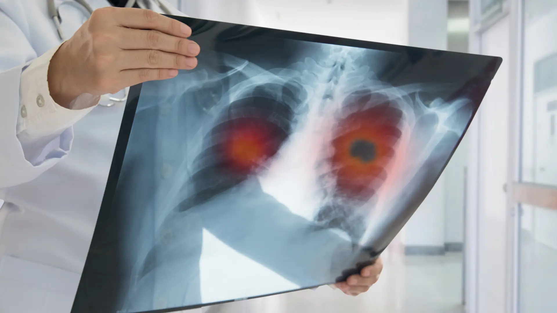EEUU aprueba un fármaco español para el tratamiento de un tipo de cáncer de pulmón muy agresivo EEUU aprueba un fármaco español para el tratamiento de un tipo de cáncer de pulmón muy agresivo