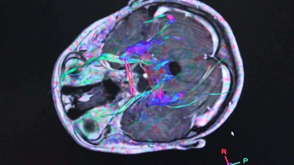Hallan un patrón en enfermedades de cerebro e intestino que mejoraría la detección del Párkinson Hallan un patrón en enfermedades de cerebro e intestino que mejoraría la detección del Párkinson