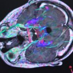 Hallan un patrón en enfermedades de cerebro e intestino que mejoraría la detección del Párkinson