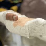 Noticias Medellín: Un joven de 22 años perdió un dedo por la polvora
