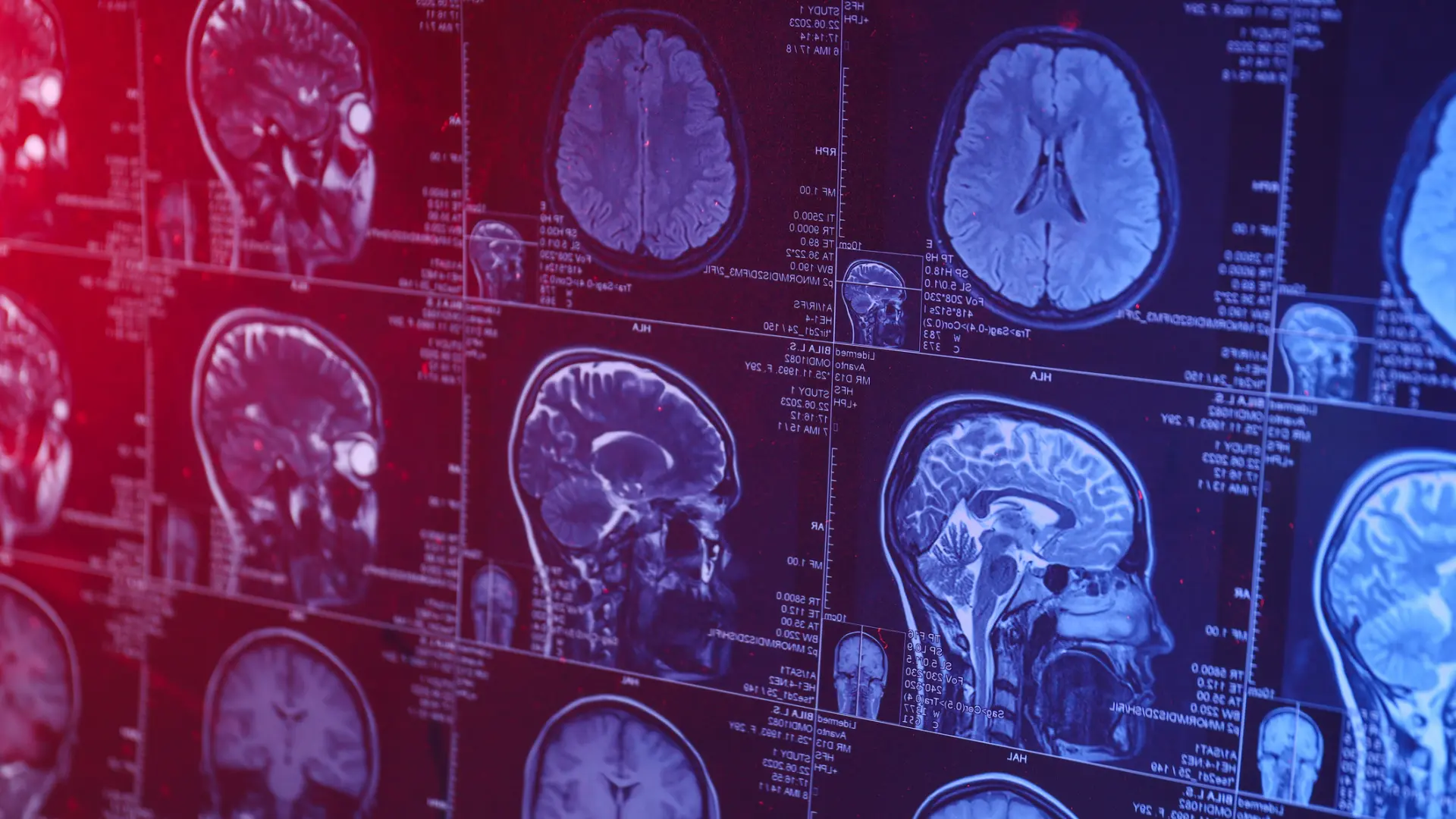 Un adolescente chino de 19 años se convierte en la persona más joven de la historia diagnosticada con alzhéimer