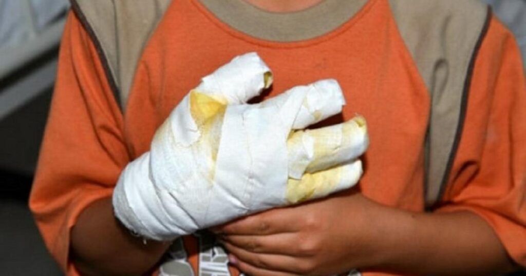 Noticias Antioquia:Por manipular ‘totes’, niño de 10 años sufrió quemaduras Noticias Antioquia:Por manipular ‘totes’, niño de 10 años sufrió quemaduras