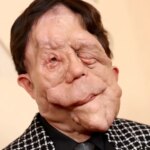 aparece en 1 de cada 2.500 personas