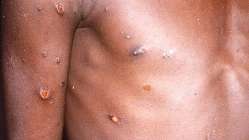 La OMS alerta del riesgo de transmisión comunitaria de mpox a menos que se contengan rápidamente los brotes existentes