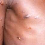 La OMS alerta del riesgo de transmisión comunitaria de mpox a menos que se contengan rápidamente los brotes existentes La OMS alerta del riesgo de transmisión comunitaria de mpox a menos que se contengan rápidamente los brotes existentes