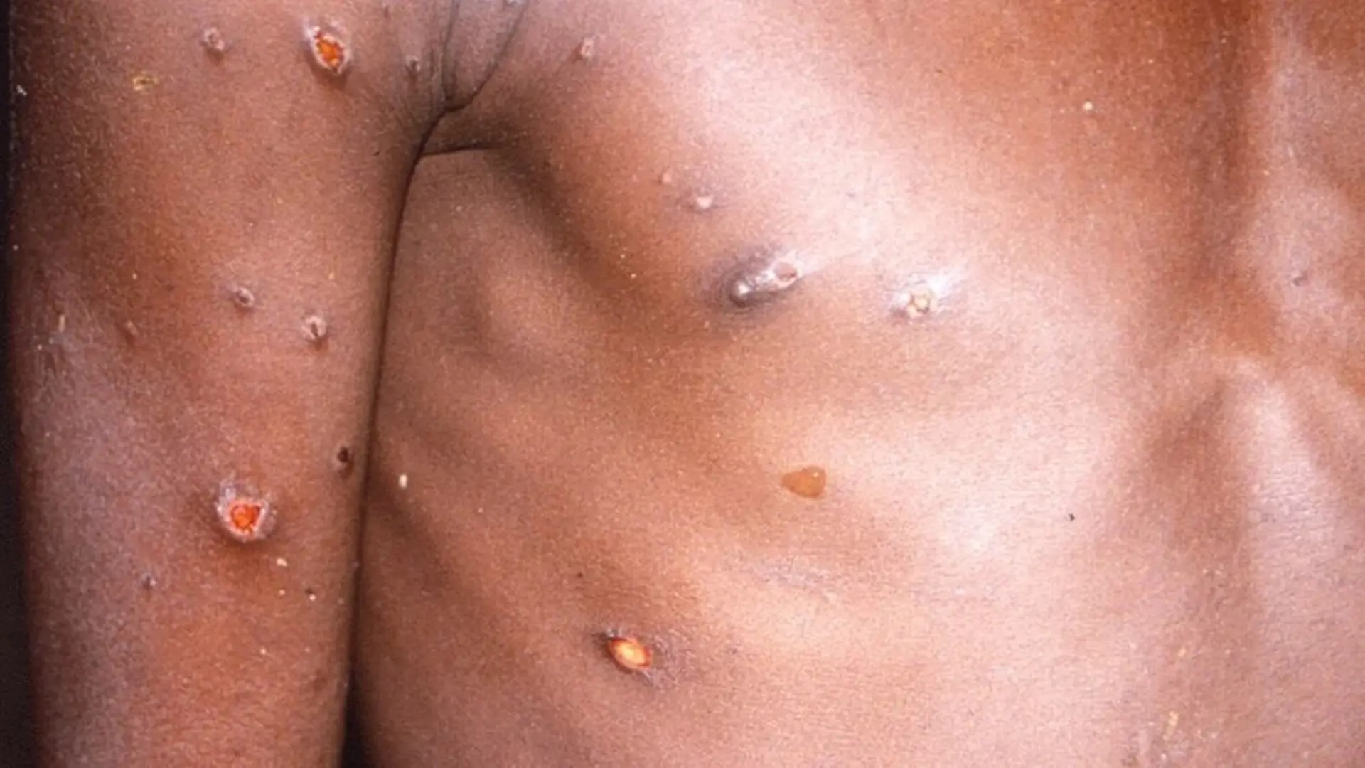 La OMS alerta del riesgo de transmisión comunitaria de mpox a menos que se contengan rápidamente los brotes existentes