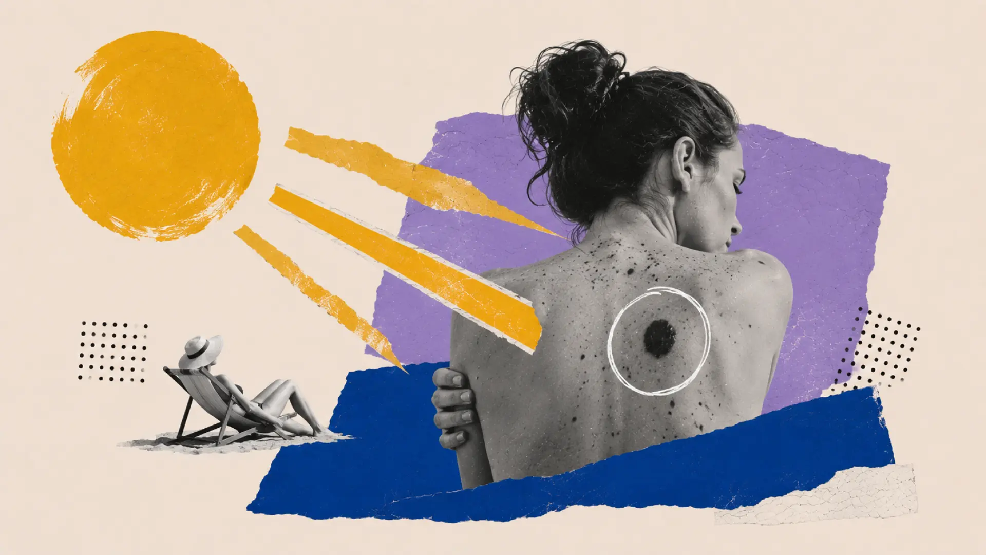 este es el riesgo de melanoma, el cáncer de piel más agresivo este es el riesgo de melanoma, el cáncer de piel más agresivo
