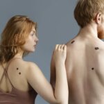 La AECC asegura que vigilar los lunares y manchas en la piel es el mejor control de los melanomas