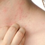 cómo prevenir esta infección dermatológica altamente contagiosa cómo prevenir esta infección dermatológica altamente contagiosa