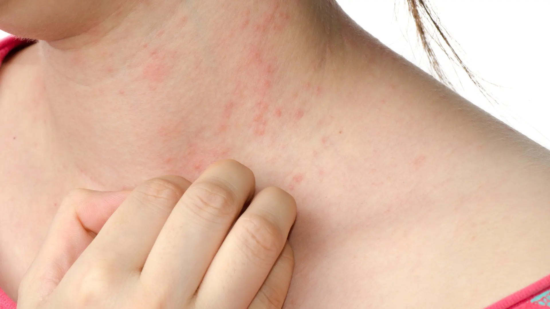 cómo prevenir esta infección dermatológica altamente contagiosa cómo prevenir esta infección dermatológica altamente contagiosa