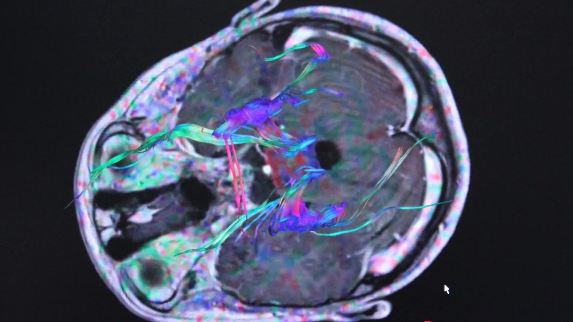 Desarrollan una innovadora prueba para detectar el cáncer cerebral que reduce el diagnóstico de semanas a horas Desarrollan una innovadora prueba para detectar el cáncer cerebral que reduce el diagnóstico de semanas a horas